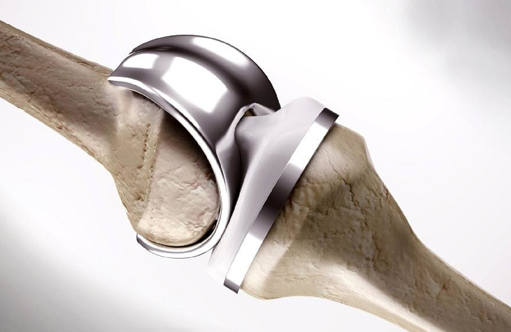 Knee Replacement Surgery